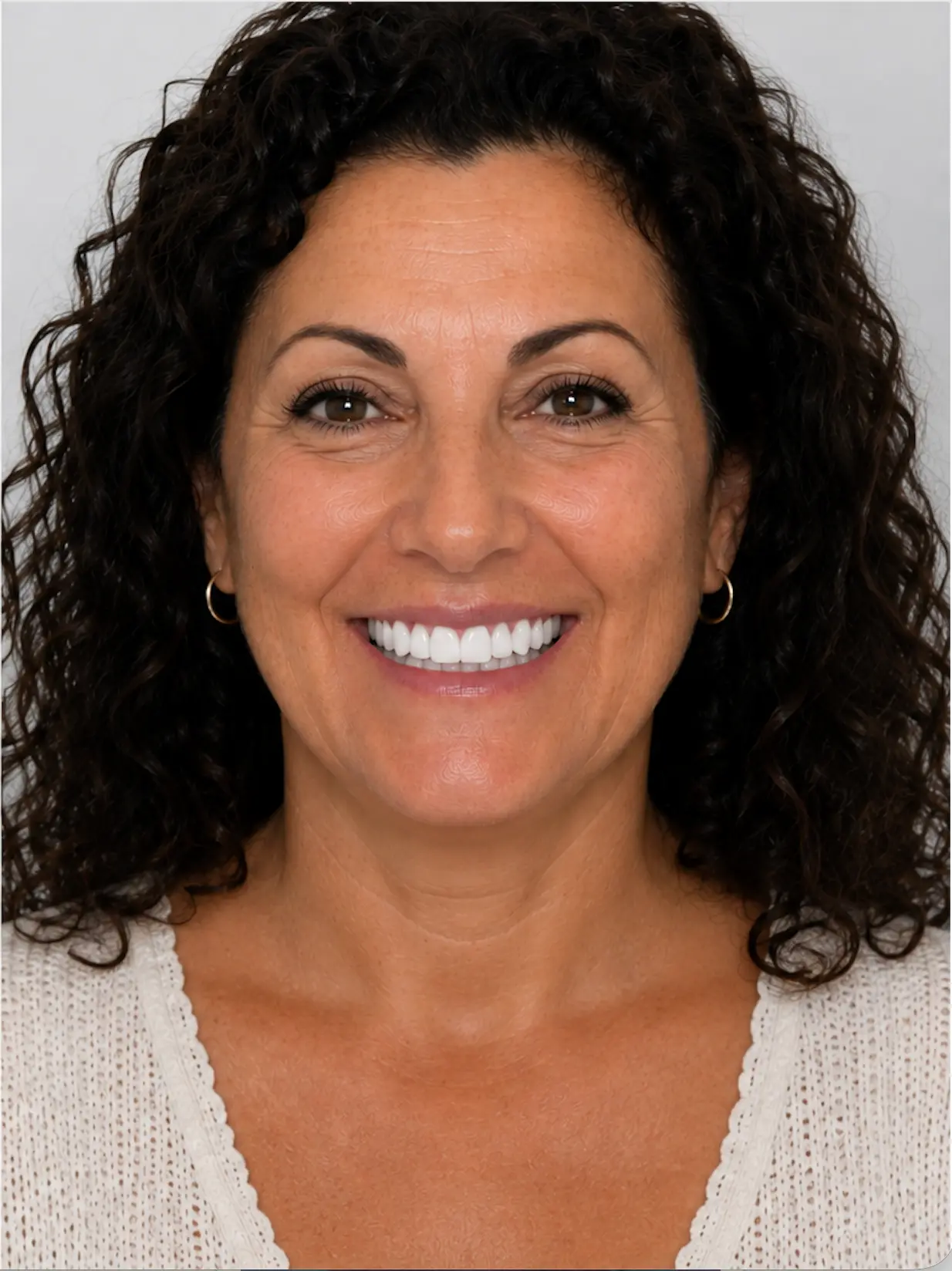 All-on-X smile transformation